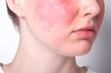 Gros plan d’un visage présentant des rougeurs cutanées, illustrant un article sur les causes et traitements des rougeurs et des peaux sensibles