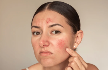 Femme examinant des imperfections sur son visage, représentant une réflexion sur les soins de la peau pour traiter les rougeurs et les irritations.