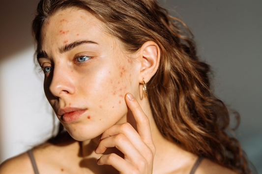 Jeune femme avec un traitement anti-imperfections appliqué sur le visage, illustrant les soins de la peau contre l’acné.