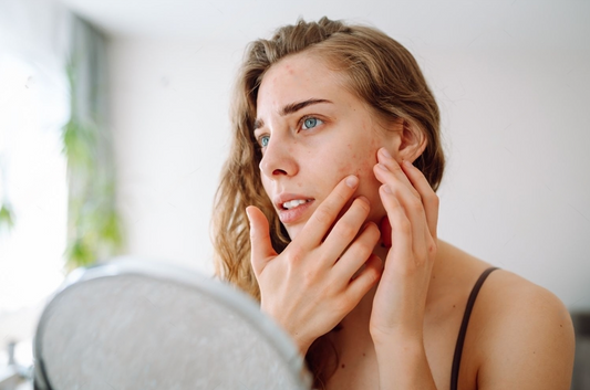 emme examinant sa peau devant un miroir, préoccupée par des imperfections. Illustration pour un article sur les soins d’hydratation pour les peaux à problèmes.